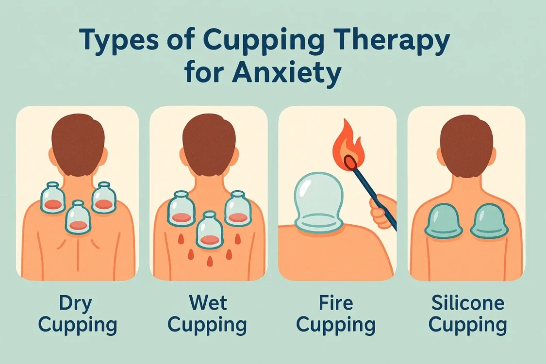 Types of Cupping Therapy for Anxiety